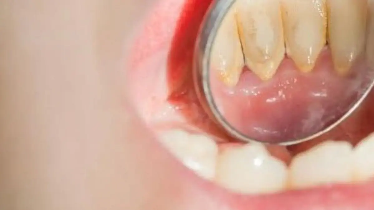 15 Cara Ampuh Menghilangkan Karang Gigi Bandel Secara Alami